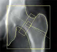 DEXA法(Dual Energy X-ray Absorptiometry)