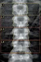 DEXA法(Dual Energy X-ray Absorptiometry)